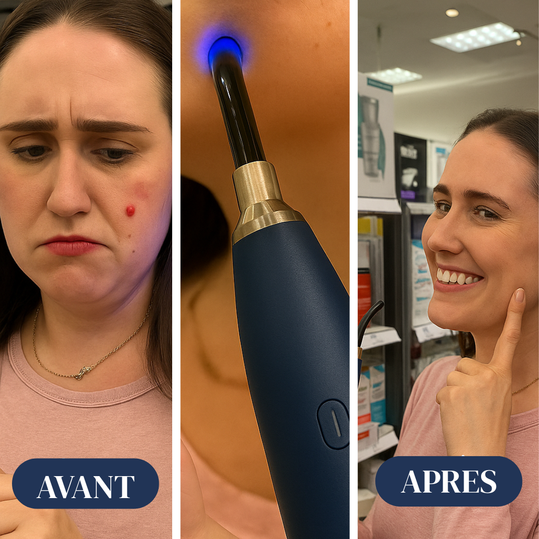 LumiSkyn™ – Appareil LED Anti-Acné Bleu & Rouge | Soin Naturel