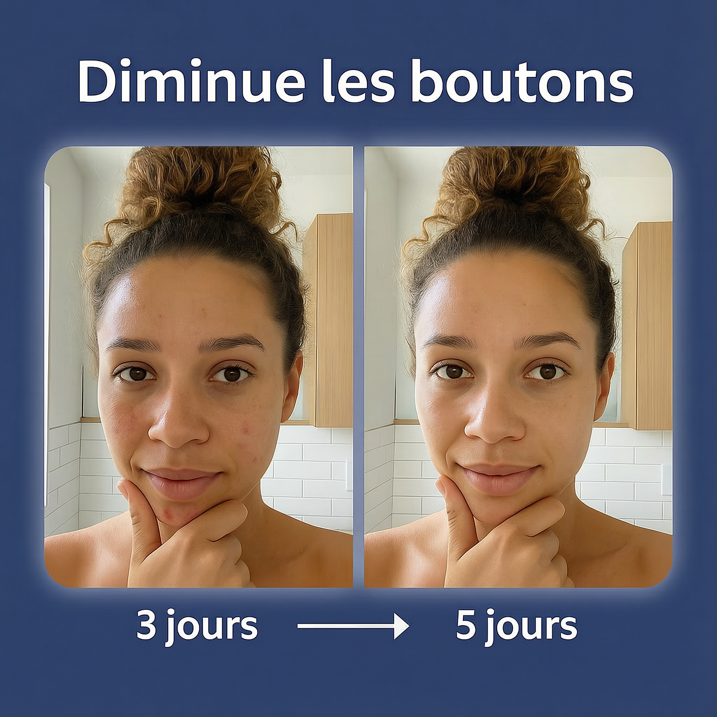 LumiSkyn™ Pro Control – Appareil LED Anti-Acné